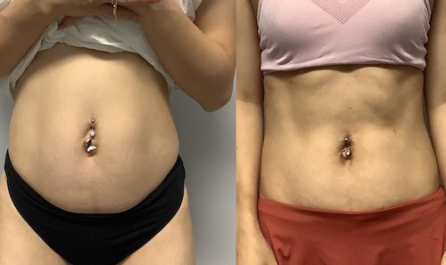 TruSculpt Fat Loss Body Sculpting Before After Mississauga Oakville